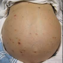 Viral Load HBV 